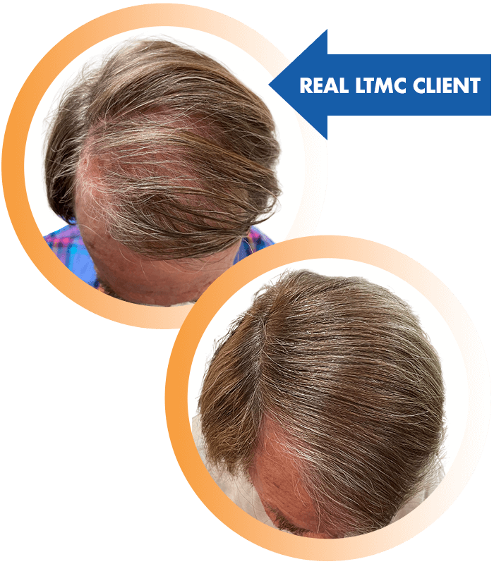 PRP, hair restoration, healthy hair, Platelet-rich plasma