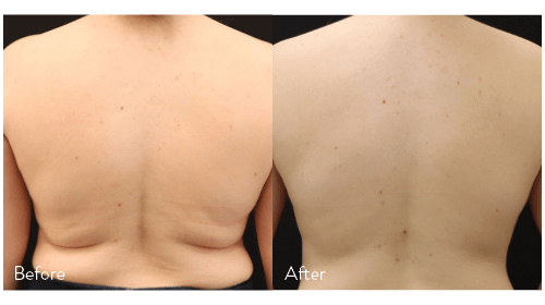 contouring, back contouring, wellness and beauty