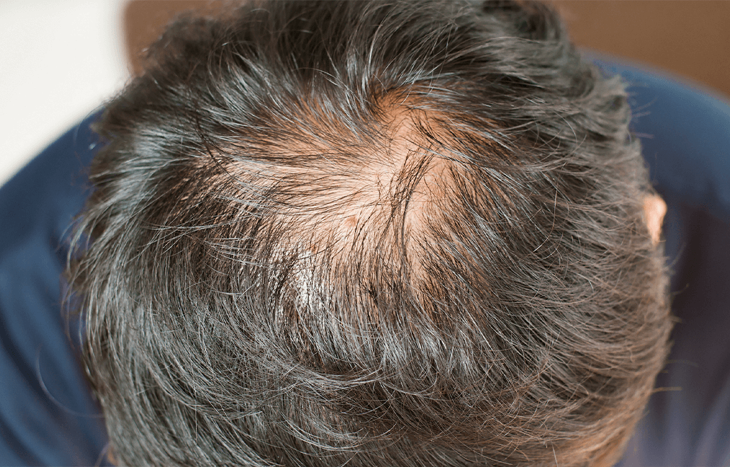 PRP, Hair Restoration, hair care, healthy hair